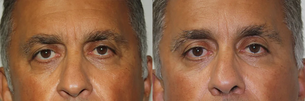 Real patient results in Newport Beach, CA Performed by Boris M. Ackerman MD