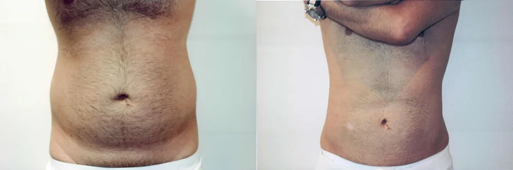 Real patient results in Newport Beach, CA Performed by Boris M. Ackerman MD