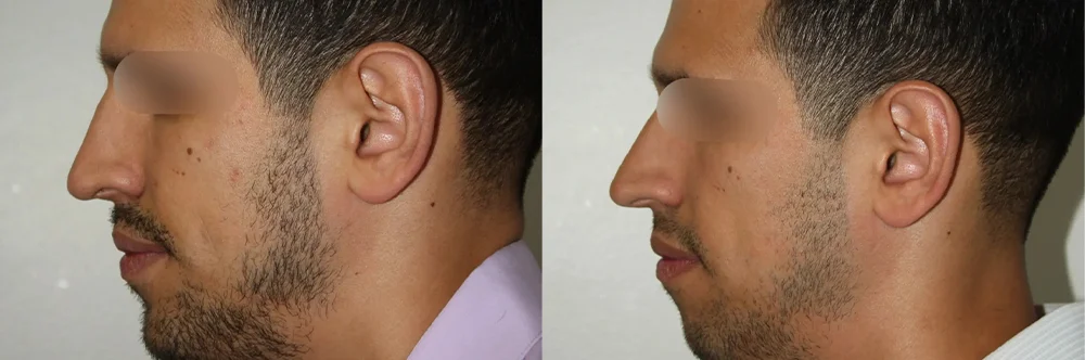Real patient results in Newport Beach, CA Performed by Boris M. Ackerman MD