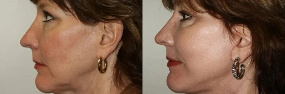 Real patient results in Newport Beach, CA Performed by Boris M. Ackerman MD