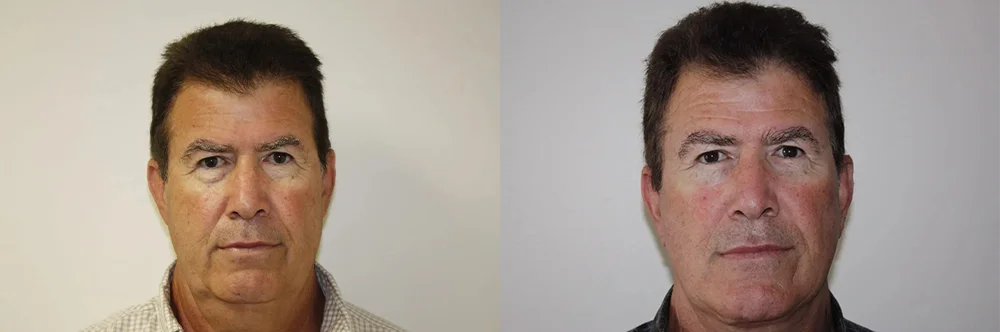Real patient results in Newport Beach, CA Performed by Boris M. Ackerman MD