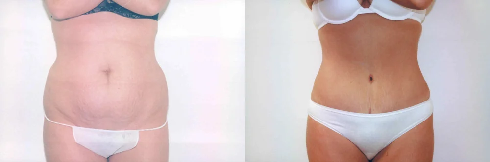 Real patient results in Newport Beach, CA Performed by Boris M. Ackerman MD