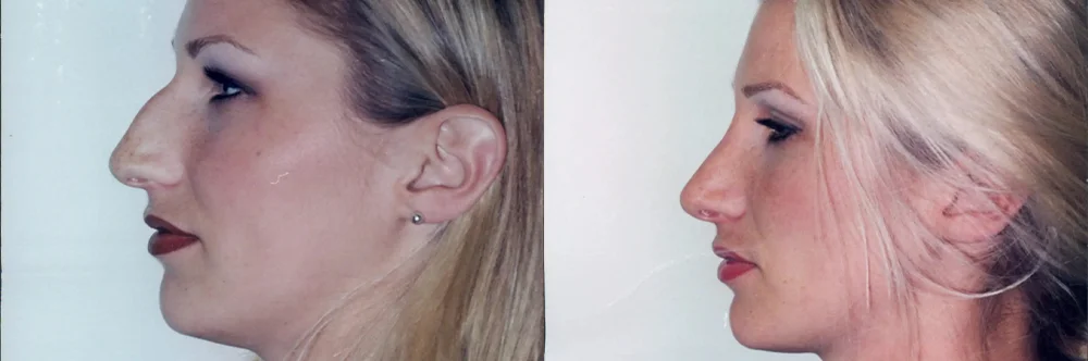 Real patient results in Newport Beach, CA Performed by Boris M. Ackerman MD