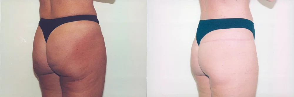 Real patient results in Newport Beach, CA Performed by Boris M. Ackerman MD