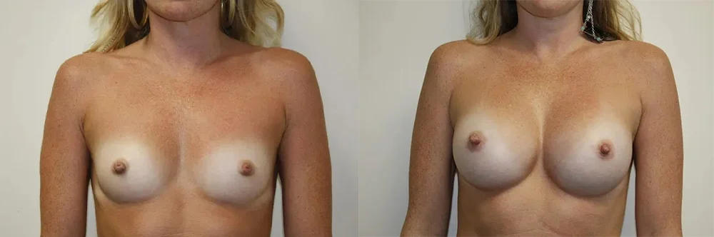 Real patient results in Newport Beach, CA Performed by Boris M. Ackerman MD