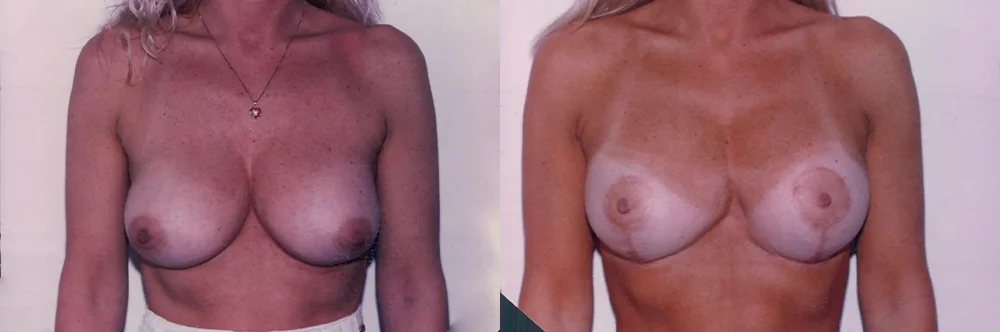 Real patient results in Newport Beach, CA Performed by Boris M. Ackerman MD