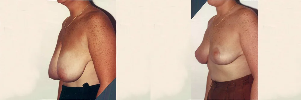 Real patient results in Newport Beach, CA Performed by Boris M. Ackerman MD