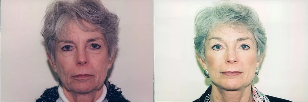 Real patient results in Newport Beach, CA Performed by Boris M. Ackerman MD