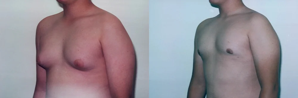 Real patient results in Newport Beach, CA Performed by Boris M. Ackerman MD