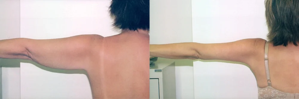 Real patient results in Newport Beach, CA Performed by Boris M. Ackerman MD
