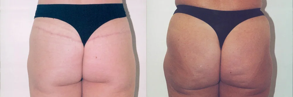 Real patient results in Newport Beach, CA Performed by Boris M. Ackerman MD