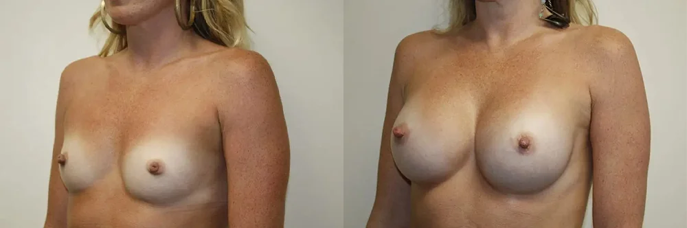 Real patient results in Newport Beach, CA Performed by Boris M. Ackerman MD