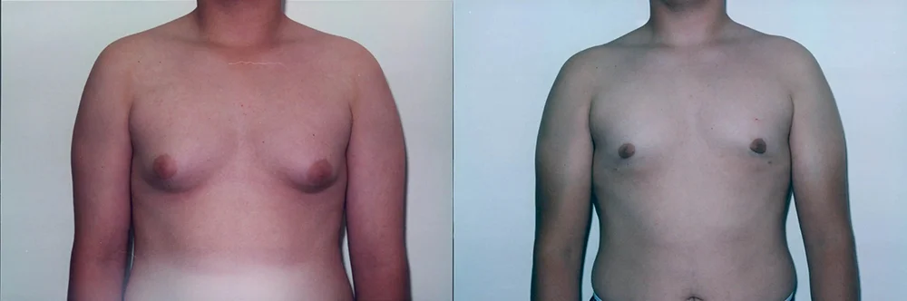 Real patient results in Newport Beach, CA Performed by Boris M. Ackerman MD