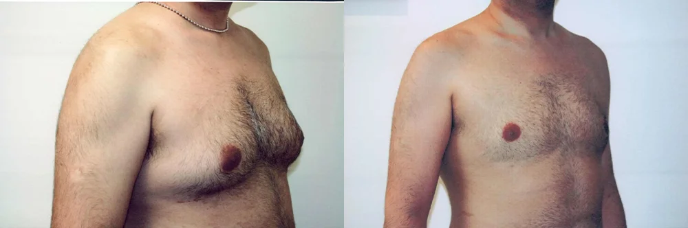 Real patient results in Newport Beach, CA Performed by Boris M. Ackerman MD