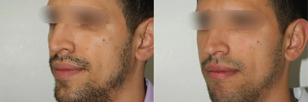 Real patient results in Newport Beach, CA Performed by Boris M. Ackerman MD