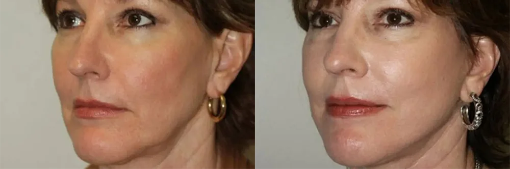 Real patient results in Newport Beach, CA Performed by Boris M. Ackerman MD