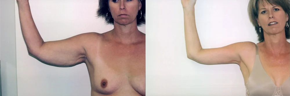 Real patient results in Newport Beach, CA Performed by Boris M. Ackerman MD