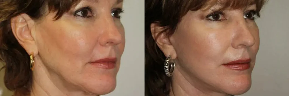 Real patient results in Newport Beach, CA Performed by Boris M. Ackerman MD