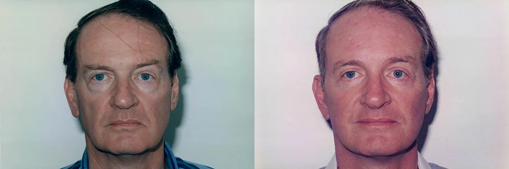 Real patient results in Newport Beach, CA Performed by Boris M. Ackerman MD