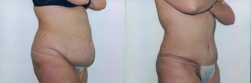 Real patient results in Newport Beach, CA Performed by Boris M. Ackerman MD