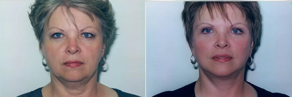 Real patient results in Newport Beach, CA Performed by Boris M. Ackerman MD