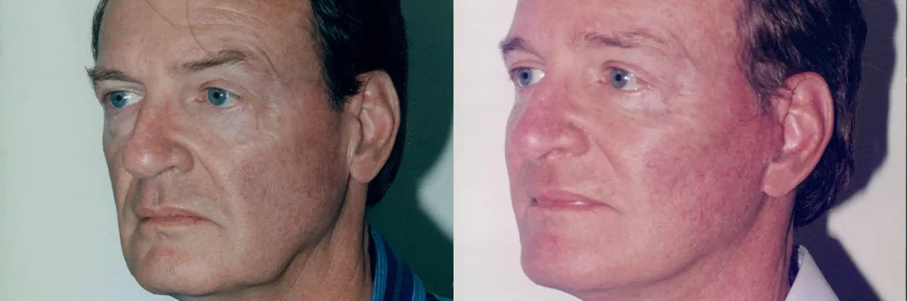 Real patient results in Newport Beach, CA Performed by Boris M. Ackerman MD