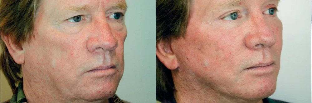 Real patient results in Newport Beach, CA Performed by Boris M. Ackerman MD