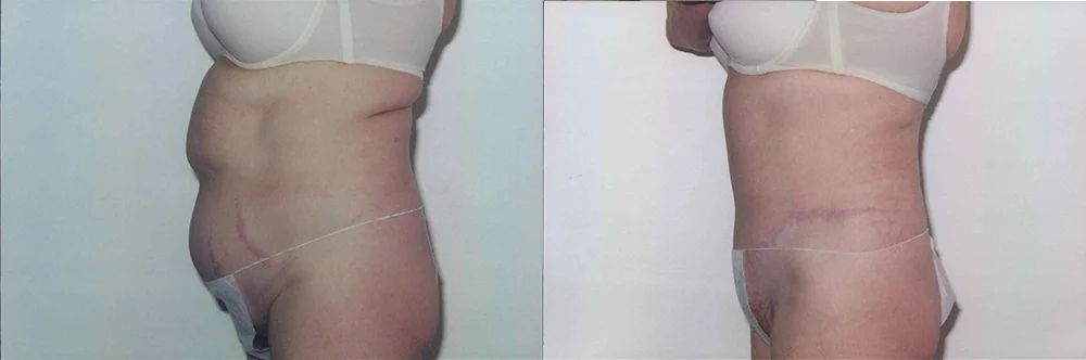Real patient results in Newport Beach, CA Performed by Boris M. Ackerman MD