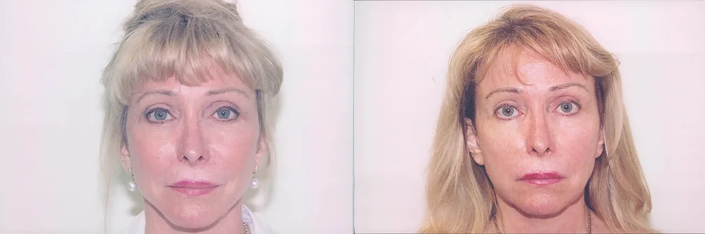 Real patient results in Newport Beach, CA Performed by Boris M. Ackerman MD