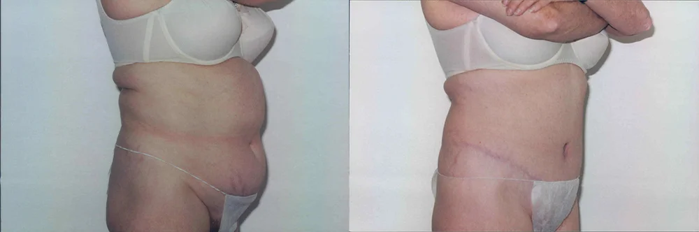 Real patient results in Newport Beach, CA Performed by Boris M. Ackerman MD