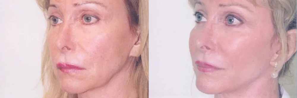 Real patient results in Newport Beach, CA Performed by Boris M. Ackerman MD