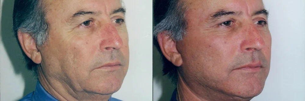Real patient results in Newport Beach, CA Performed by Boris M. Ackerman MD