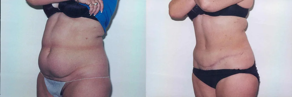 Real patient results in Newport Beach, CA Performed by Boris M. Ackerman MD