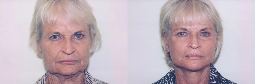 Real patient results in Newport Beach, CA Performed by Boris M. Ackerman MD