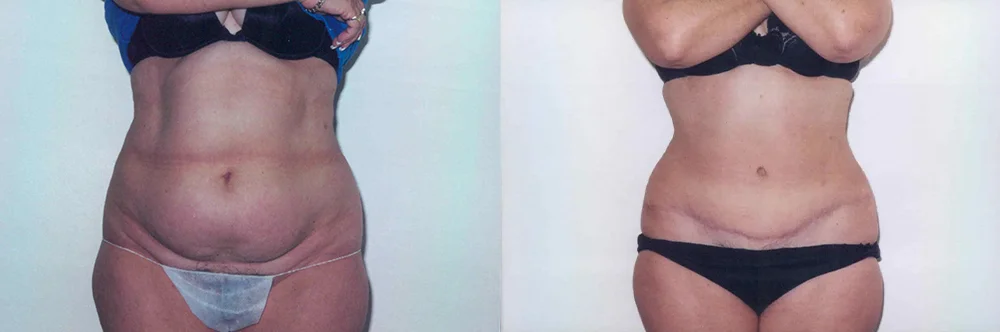 Real patient results in Newport Beach, CA Performed by Boris M. Ackerman MD
