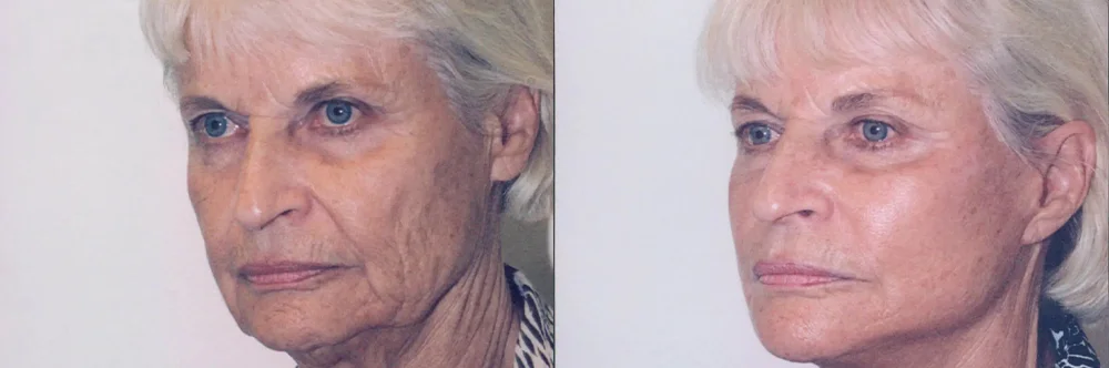 Real patient results in Newport Beach, CA Performed by Boris M. Ackerman MD