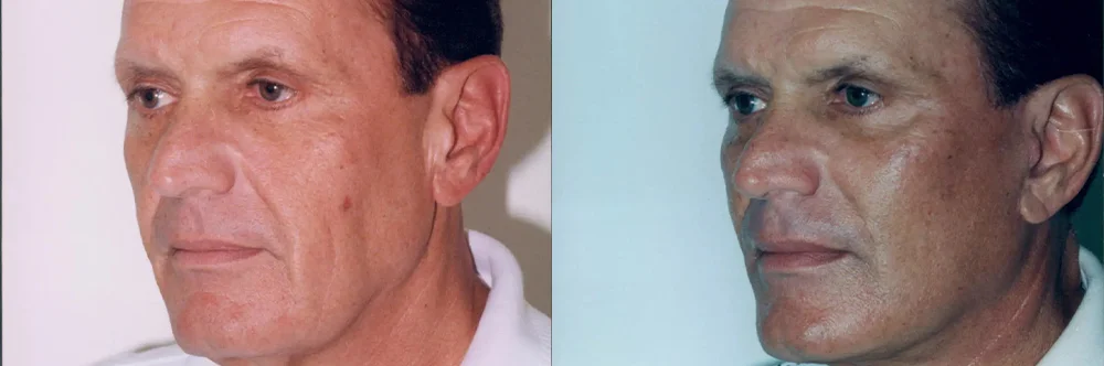 Real patient results in Newport Beach, CA Performed by Boris M. Ackerman MD