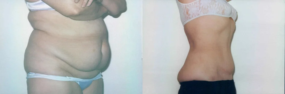Real patient results in Newport Beach, CA Performed by Boris M. Ackerman MD
