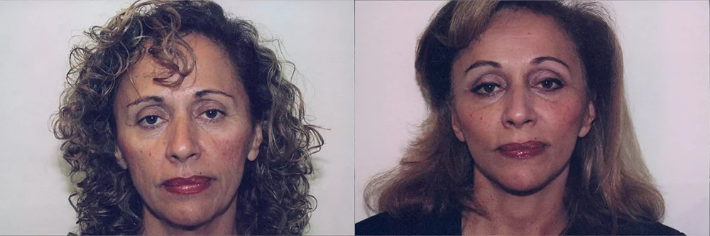 Real patient results in Newport Beach, CA Performed by Boris M. Ackerman MD