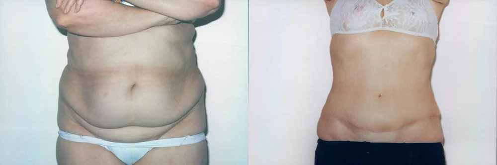 Real patient results in Newport Beach, CA Performed by Boris M. Ackerman MD