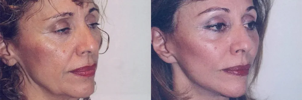 Real patient results in Newport Beach, CA Performed by Boris M. Ackerman MD