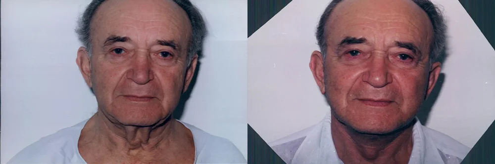 Real patient results in Newport Beach, CA Performed by Boris M. Ackerman MD