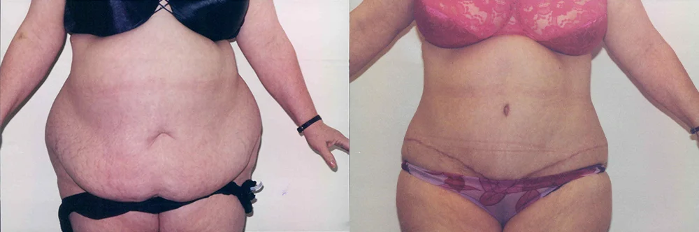 Real patient results in Newport Beach, CA Performed by Boris M. Ackerman MD