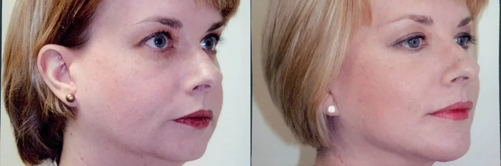Real patient results in Newport Beach, CA Performed by Boris M. Ackerman MD