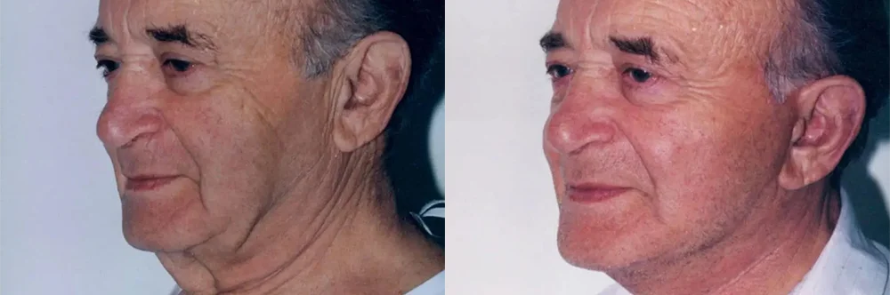 Real patient results in Newport Beach, CA Performed by Boris M. Ackerman MD