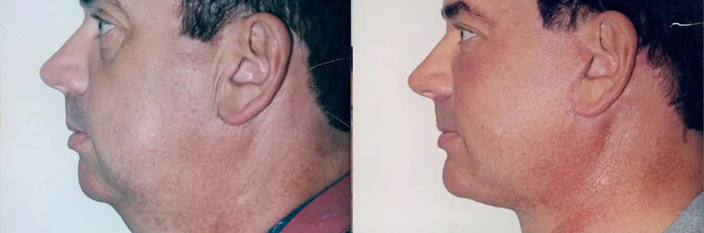 Real patient results in Newport Beach, CA Performed by Boris M. Ackerman MD
