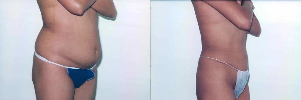 Real patient results in Newport Beach, CA Performed by Boris M. Ackerman MD