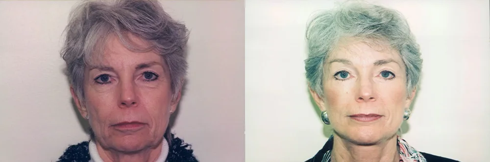 Real patient results in Newport Beach, CA Performed by Boris M. Ackerman MD