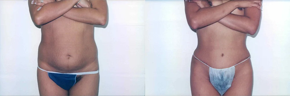 Real patient results in Newport Beach, CA Performed by Boris M. Ackerman MD