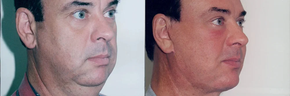 Real patient results in Newport Beach, CA Performed by Boris M. Ackerman MD